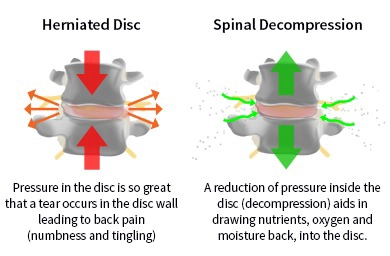 Chiropractic Garden City NY Spinal Decompression